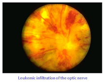 ocular manifetstaion in leukamia