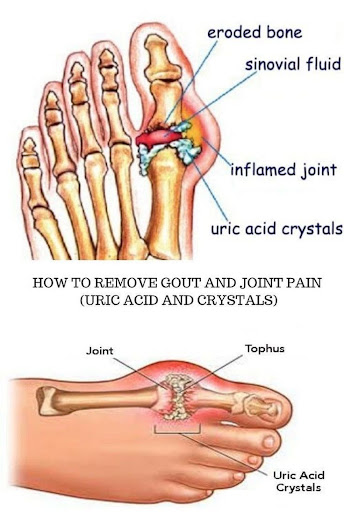 do statins cause joint pain