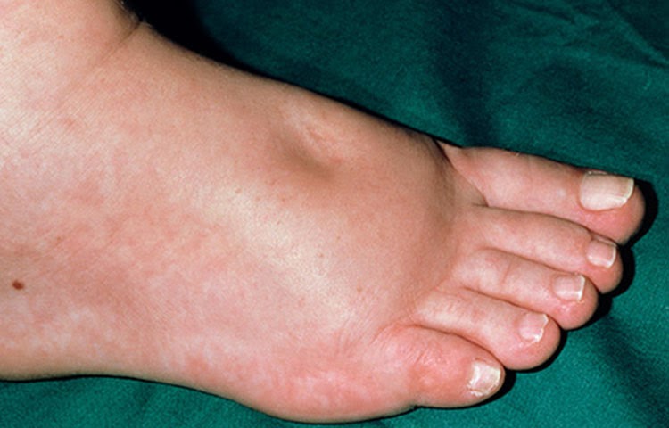 what causes swollen ankles