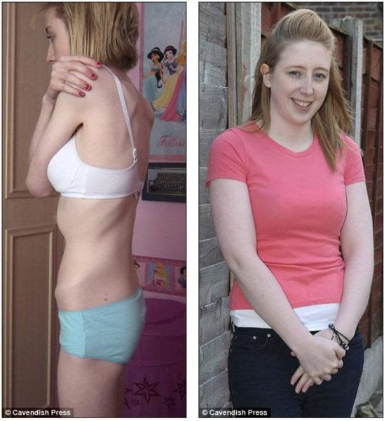 Positive Before and After Pics of Eating Disorder Sufferers