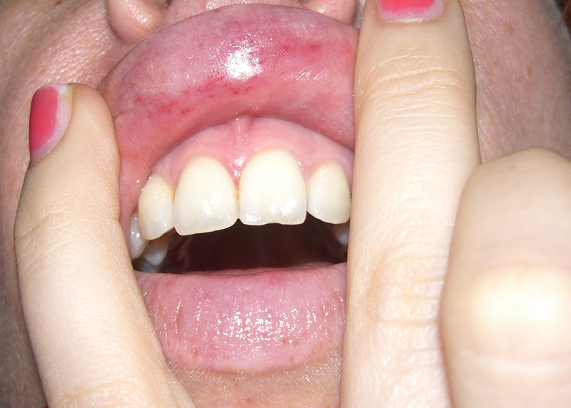 Hpv labbra sintomi. Puncte pentru setarea lipitori pentru organele genitale masculine varicoase
