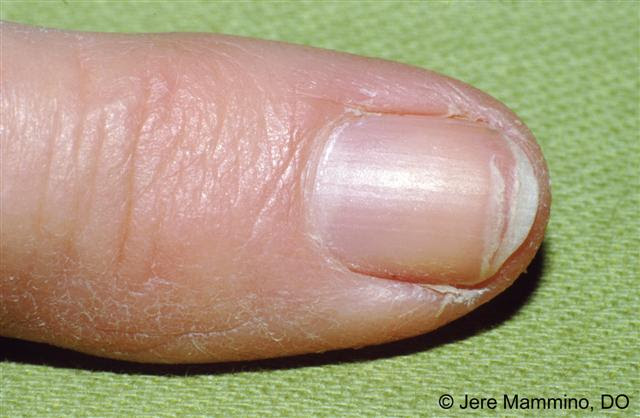 Darkening of the nail bed due to vitamin deficiency - wide 9