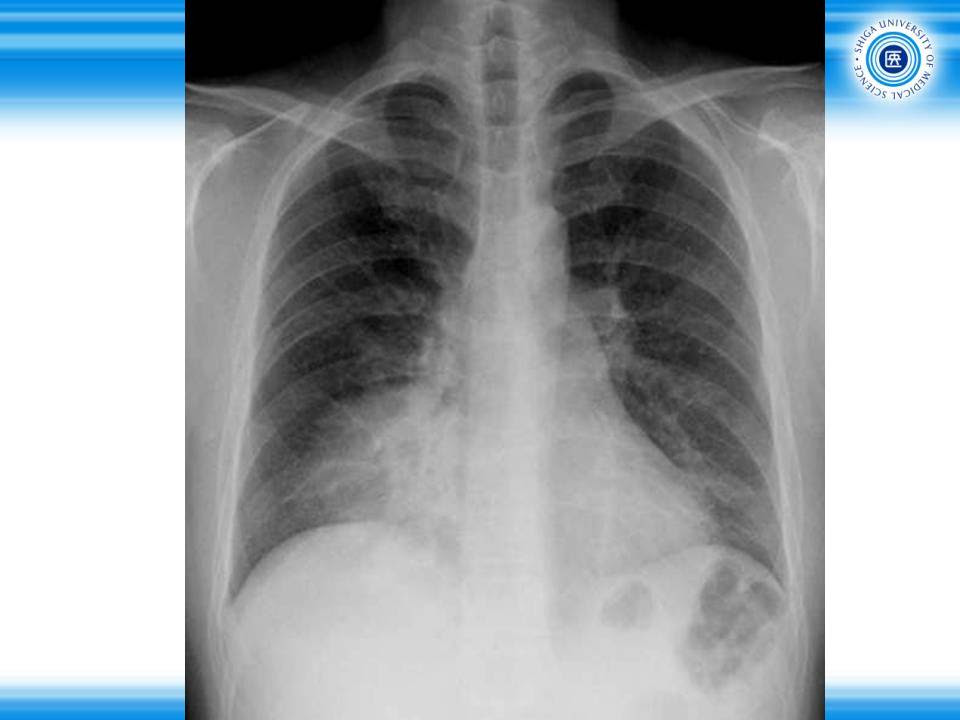 肺がん X線画像