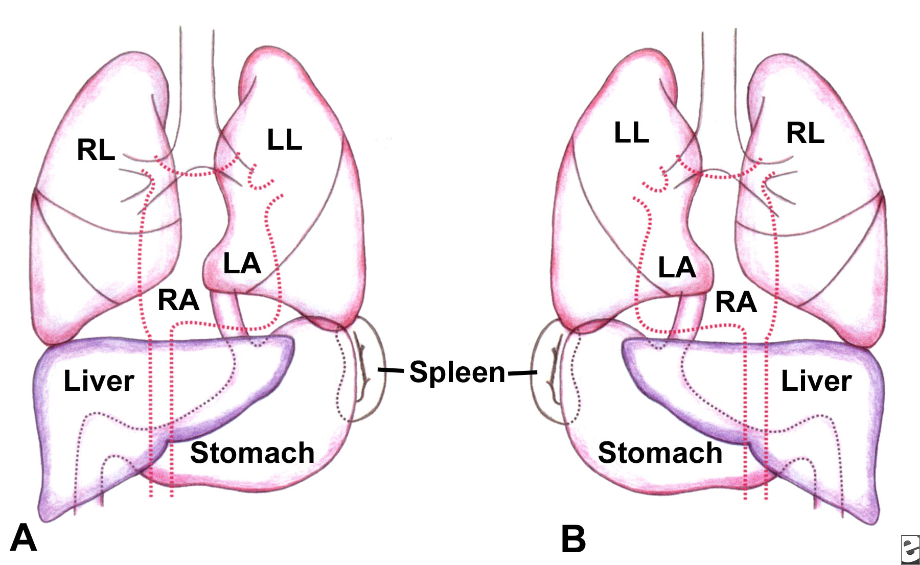 Injektileto situs inversus