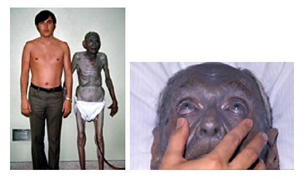 File:Argyria 2.jpg