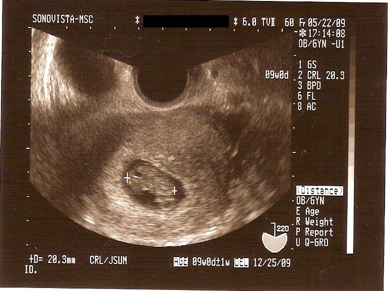 上 妊娠初期 胎児 小さい 249957妊娠初期 胎児 小さい