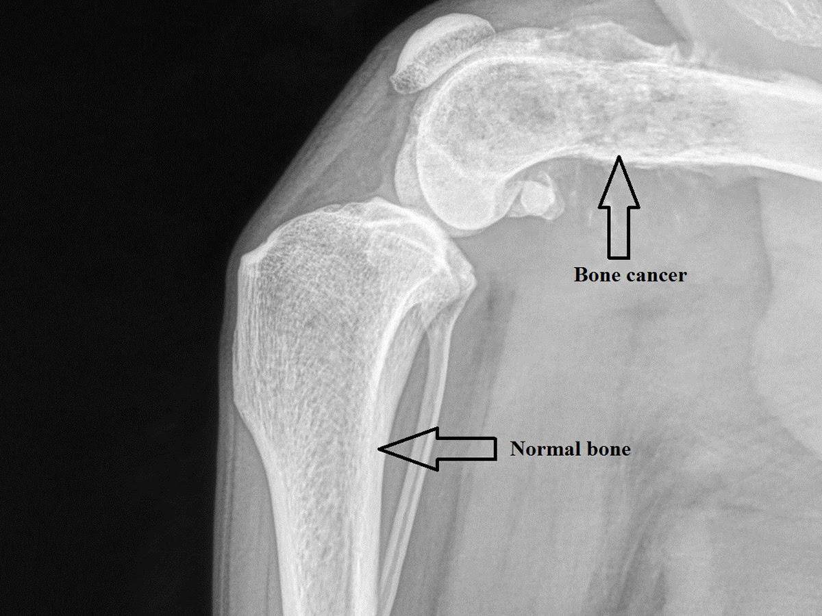 Symptoms Of Bone Cancer In Shoulder - Bone Tumor: Types, Causes, and ...