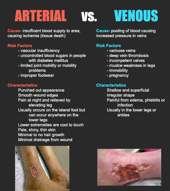 Arterial Ulcer Vs Diabetic Ulcer DiabetesWalls   3ICvIUD0C3VuqDnjp SUosjlExfB6cVSXGMVNzA8vfxs5vjmaJEQX320N1ZyfXBpOpvD VUzqpbm5ojd2 FlopVXzuQPurReM74qq2qCA8bNiuzliuXVOm6LGEE69A=s0 D