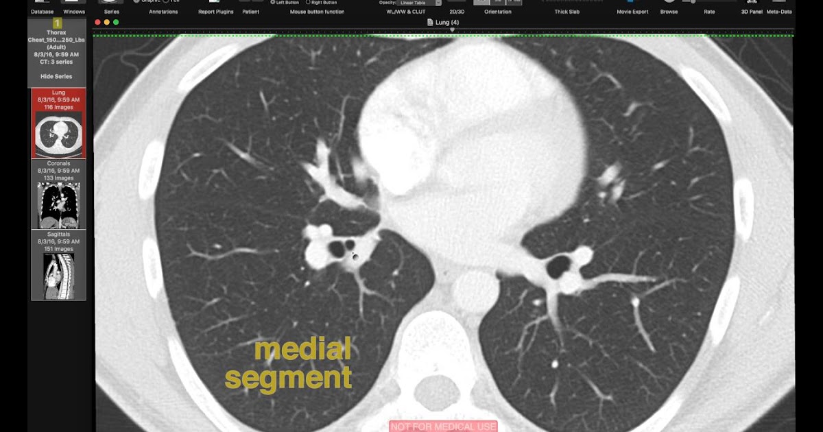 Lung Segmental Anatomy - Anatomy Diagram Book