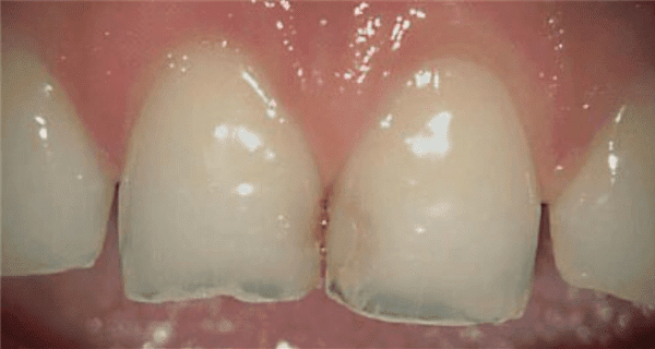 cavities dentist teeth