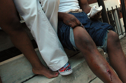 gunshot wound leg _2 web.jpg