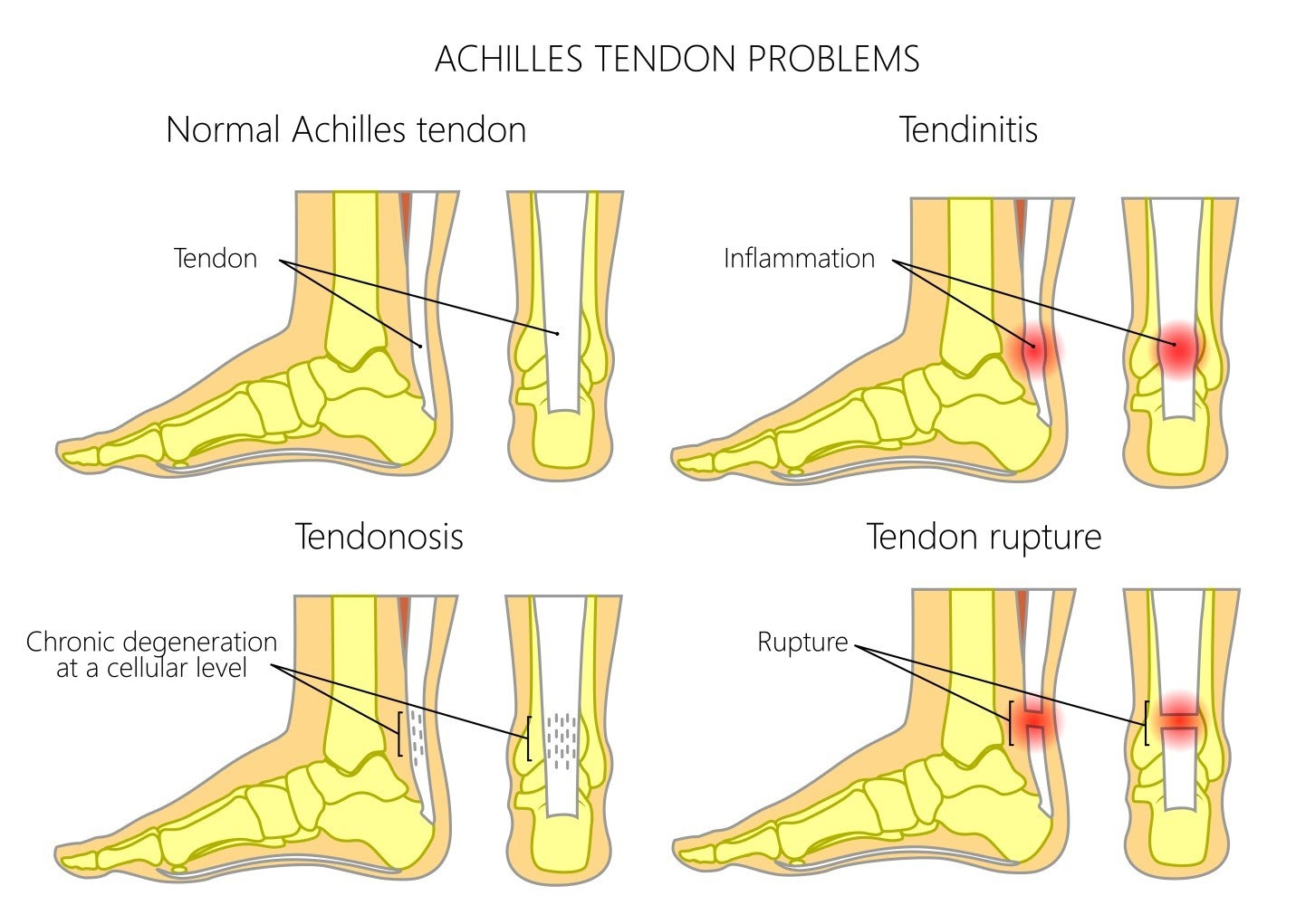 Exercises For Extensor Tendonitis In Foot - Exercise Poster