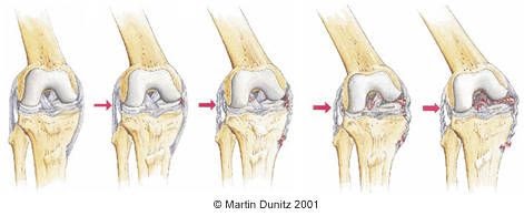 How Long Does It Take For An Mcl Sprain To Heal - Tim Berman Kapsels