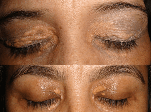 BỆNH U VÀNG Ở MẮT (Xanthelasma palpebrarum )