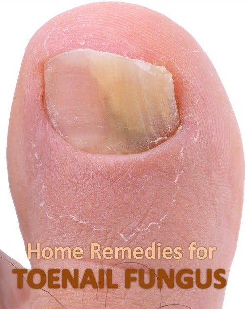 Home Remedies for Toenail Fungus | Active Home Remedies