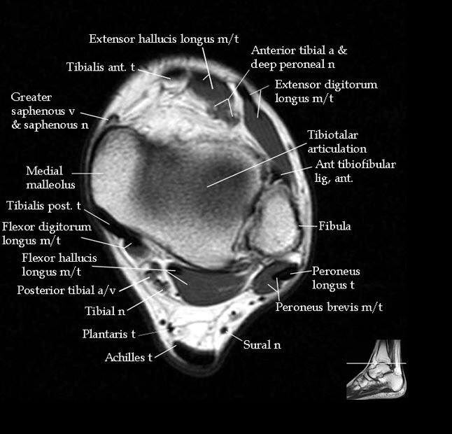 Knee Muscle Anatomy Mri / MRI shoulder anatomy | shoulder coronal ...