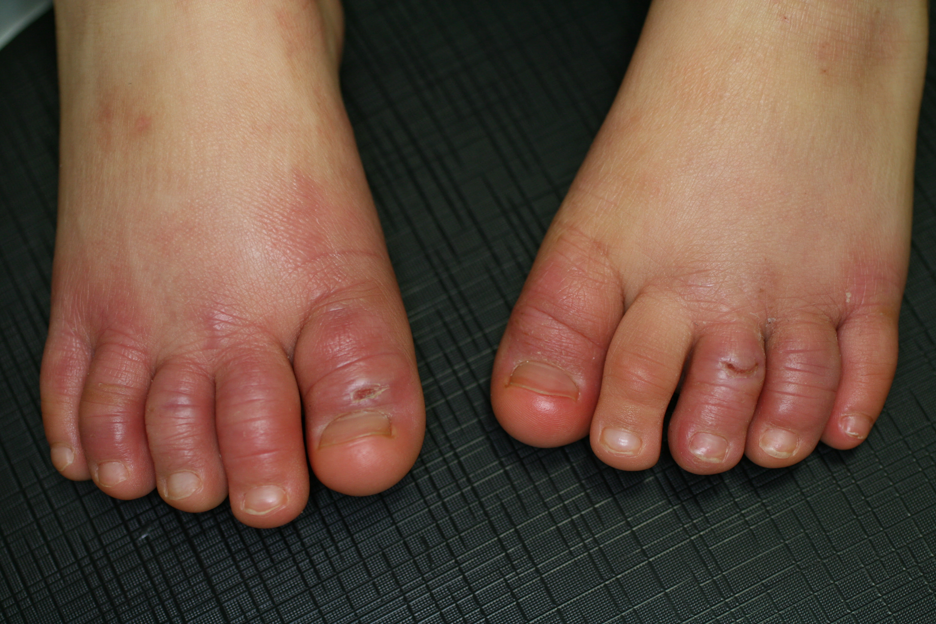 [10000ダウンロード済み√] 赤ちゃん 足の指 湿疹 302636赤ちゃん 足の指 湿疹