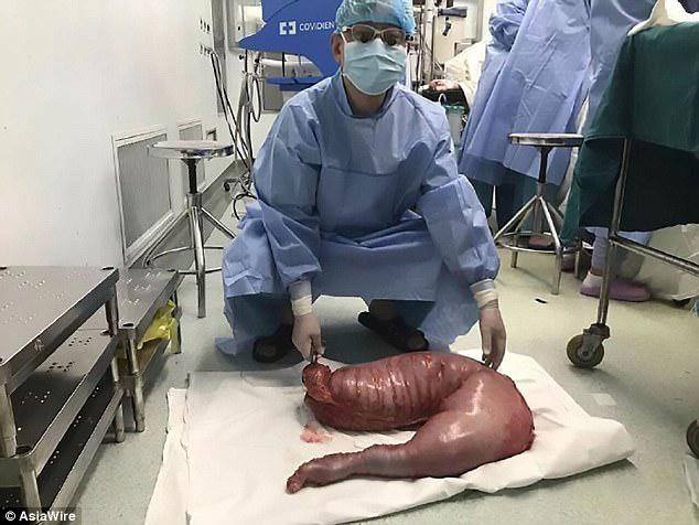 Hirschsprung's disease affects one in every 5,000 babies. Pictured: Doctor with section of colon removed from the unnamed 22-year-old chinese man with Hirschsprung's disease