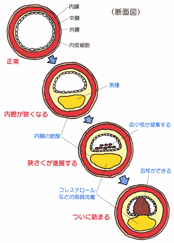 最高のイラスト画像 50 素晴らしい動脈 硬化 イラスト