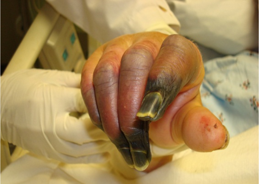 Sepsis Finger - Sepsis from nail-biting hospitalizes U.K ...