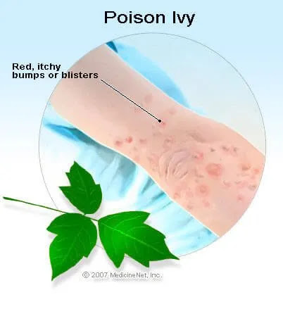 Picture of Poison Ivy Plant and Poison Ivy Skin Rash