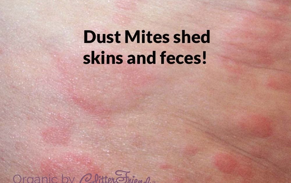 What Do Bedbug Bites Look Like On Human Skin Pictures Dowta