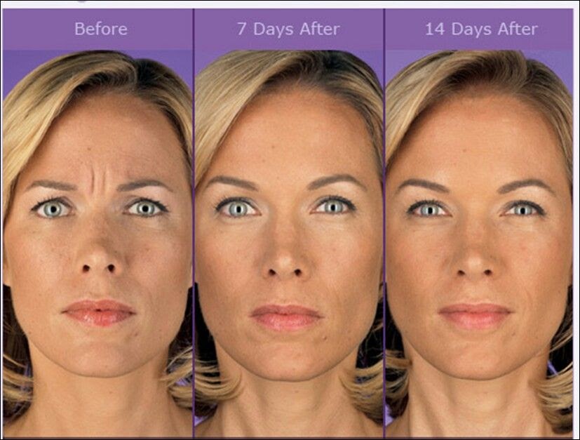 30 Minute Can i workout the day after botox for Beginner