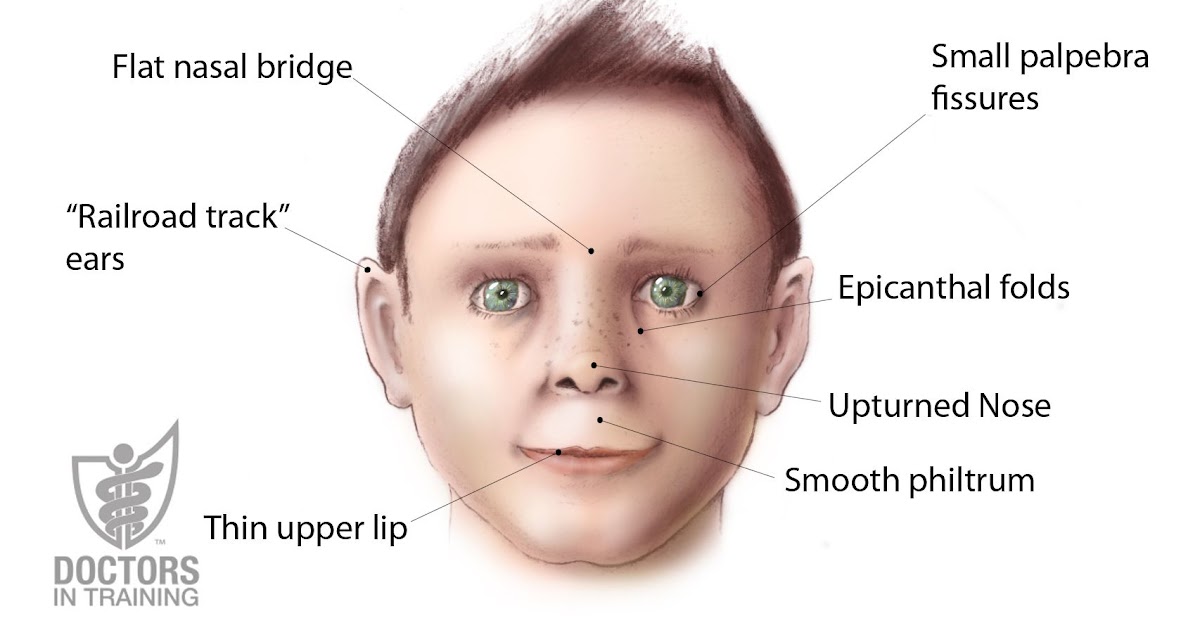 Flat Nasal Bridge And Epicanthal Folds - BK Plastic Surgery: BK Plastic ...