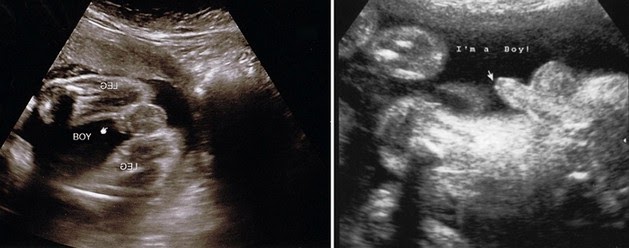 Ultrasound Images Of Baby Boy At 27 Weeks - Baby Viewer