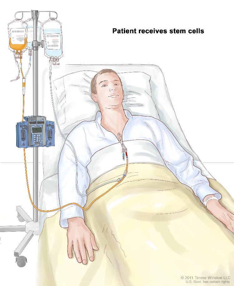 Childhood Acute Lymphoblastic Leukemia Treatment PDQ Childhood Acute Lymphoblastic Leukemia Treatment PDQ