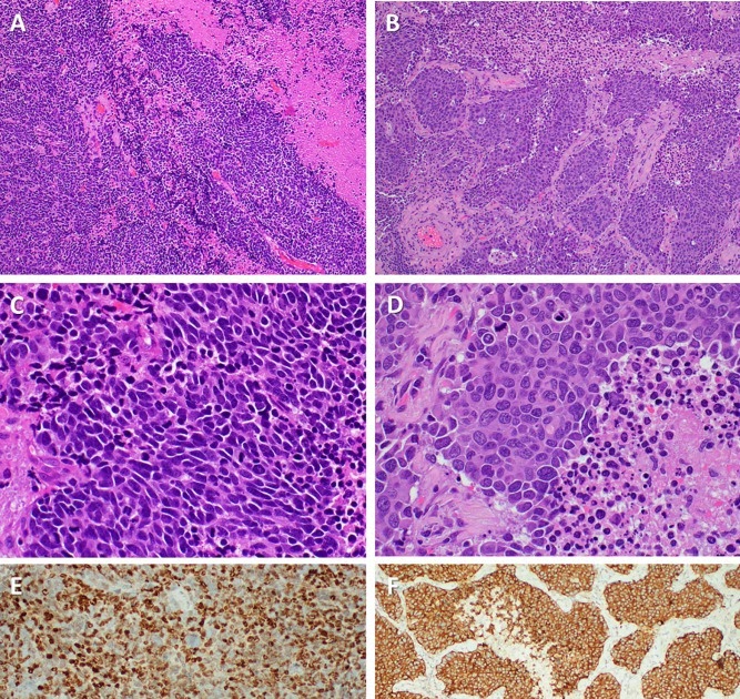 Azzopardi Effect Small Cell Carcinoma Lung Tumors