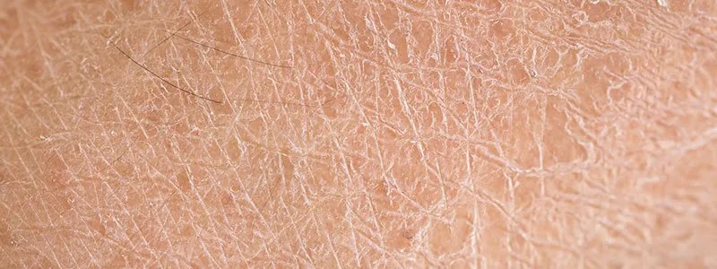 How To Get Rid Of Dry Patches On Skin Rey Hithorable