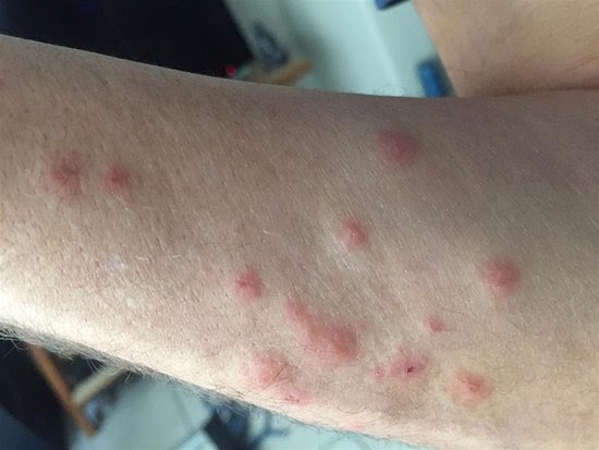 Bed Bugs Bites Arms Bed Bugs Ogok