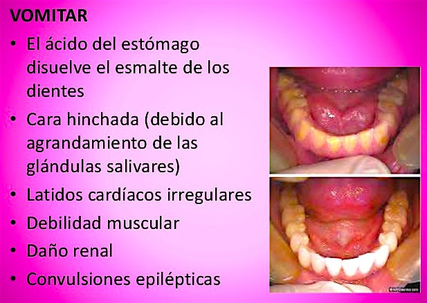 vomitos