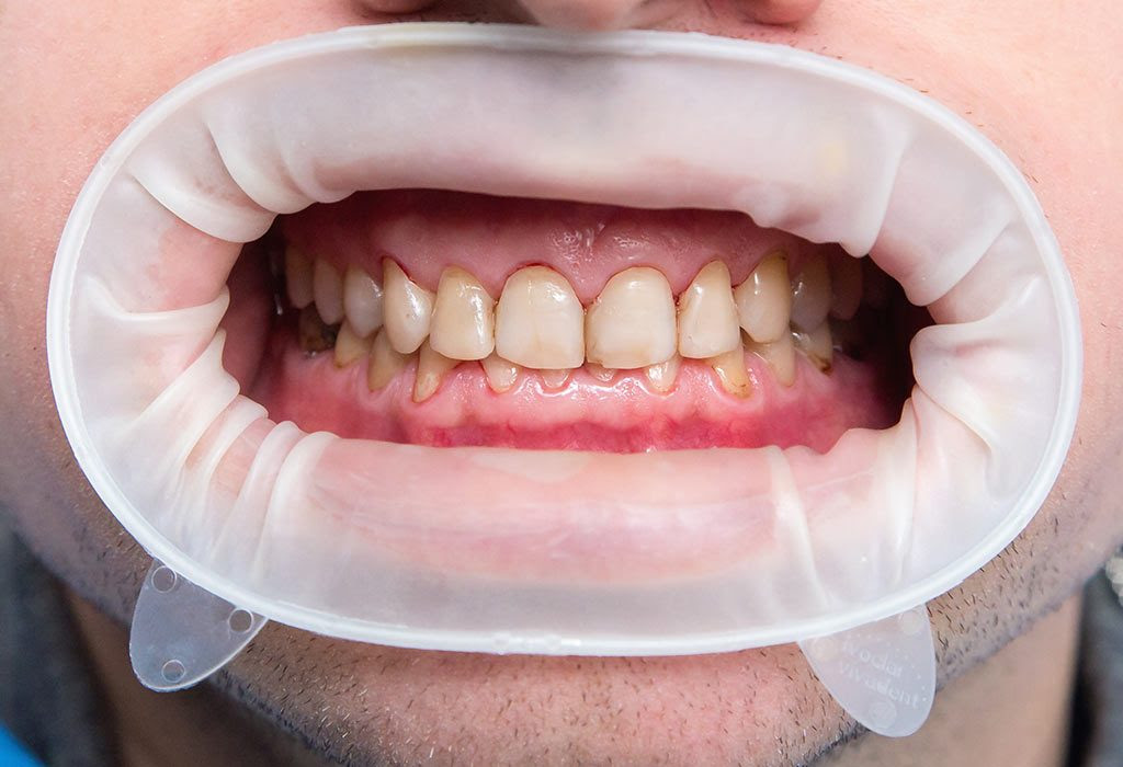discoloration braces appendicitis