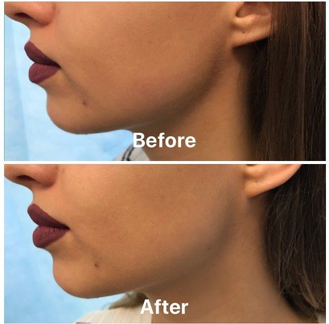 How To Create A More Defined Jawline - Create Info