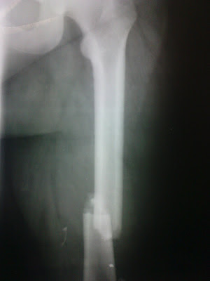 ER: A Shift in the Night: Femor fracture in MVA