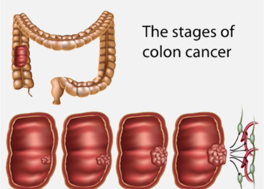 can ovarian cancer spread to the colon