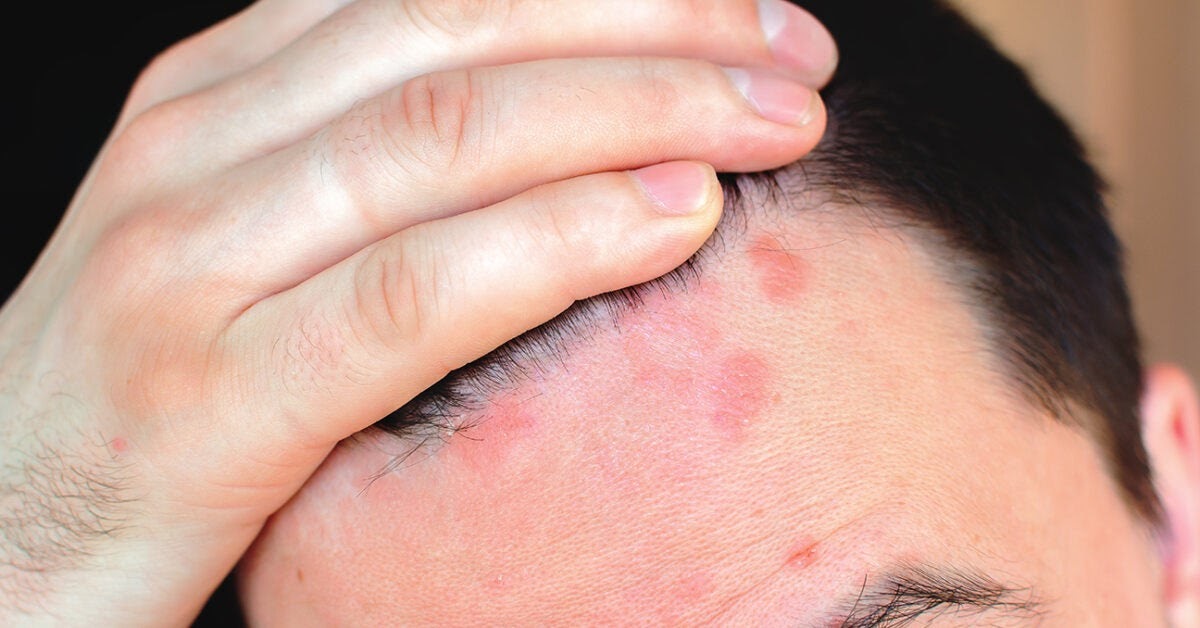 Red spots on scalp: Pictures, causes, and treatments - Medical News Today