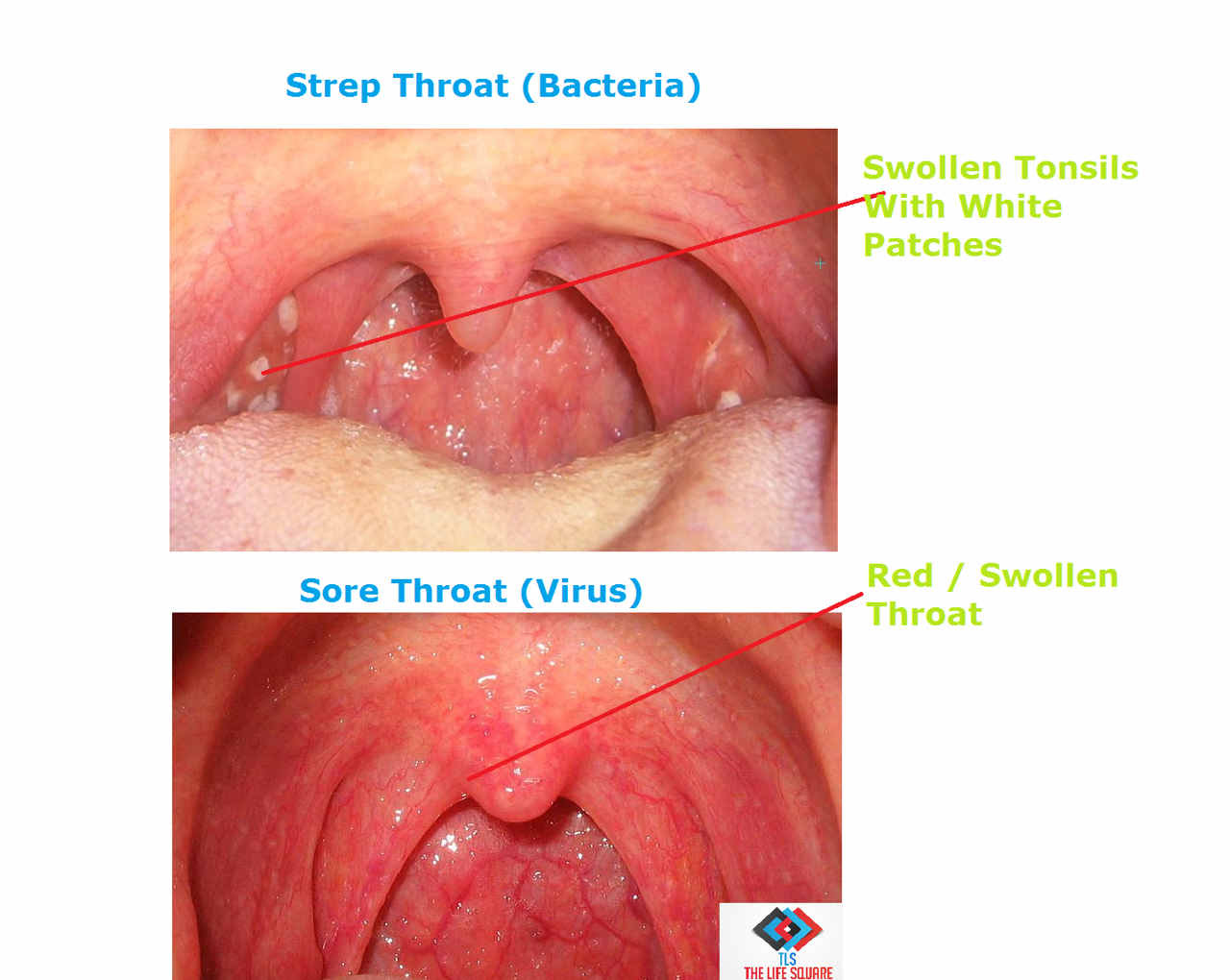 throat adult spleen without in Strep