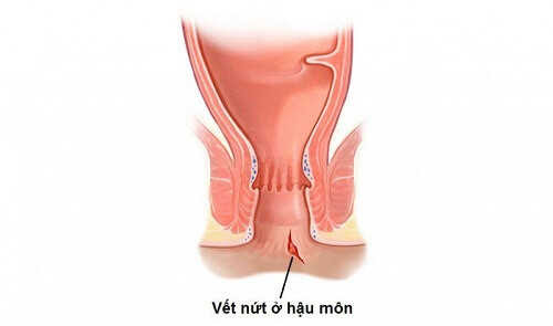 Nứt kẽ hậu môn