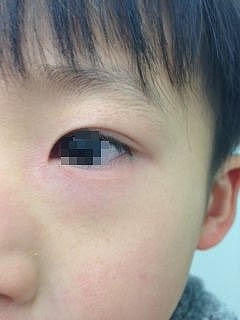 かわいい子供たちの画像: 最高かつ最も包括的な目の周り 湿疹 ...