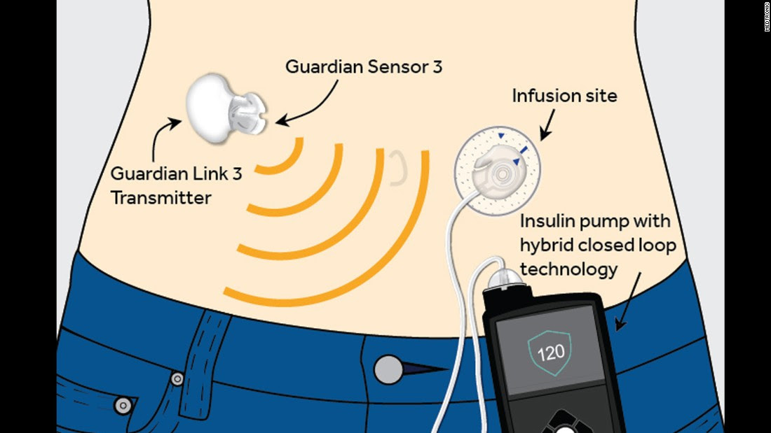 Guardian sensor 3. Сенсор Гардиан. Applied Diabetes research Insulin Infusion System.