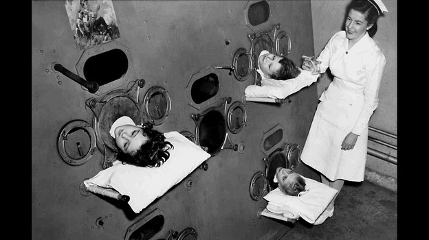 During the peak of the polio epidemic in the U.S., some hospital wards even had large, room-like iron lungs where multiple children lived. During the peak of the polio epidemic in the U.S., some hospital wards even had large, room-like iron lungs where multiple children lived.