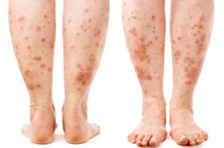 does-diabetes-cause-a-rash-on-legs-diabeteswalls