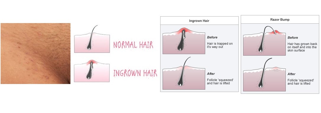 Hair Treatment in Balaghat - Ingrown Hair Home Treatment.
