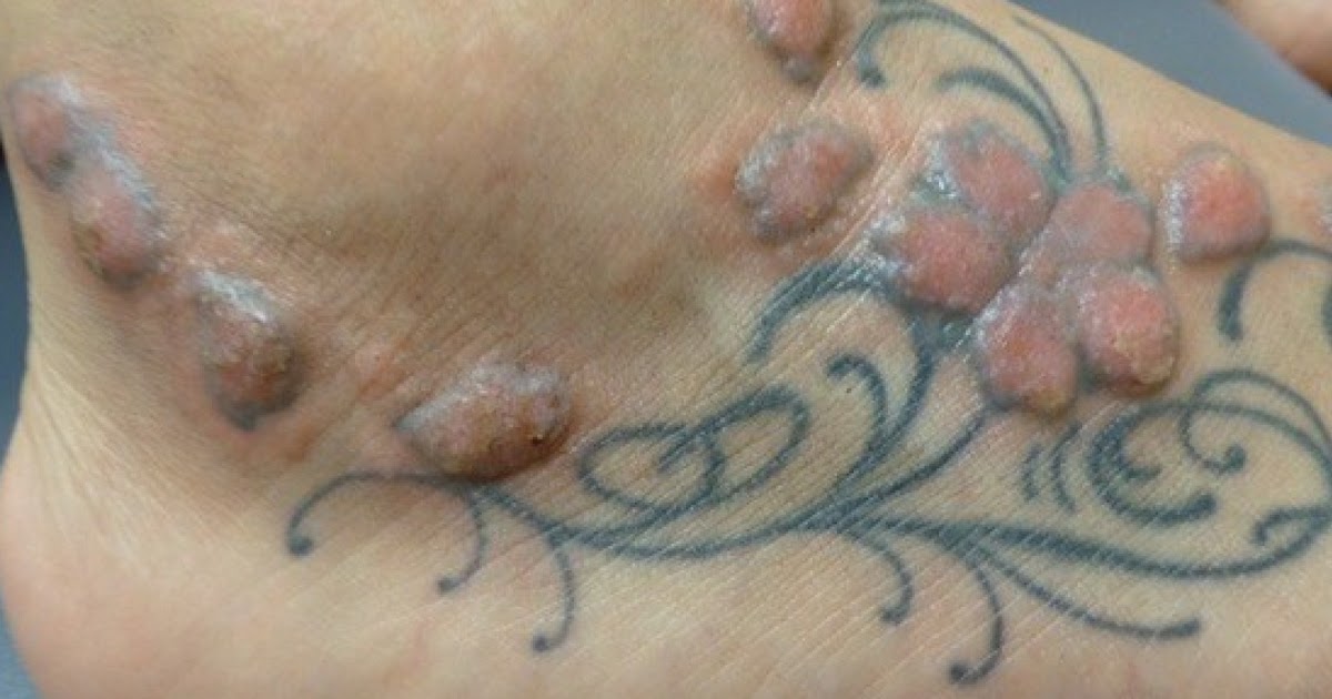 B A My Mole Removal Healing Journey Skincareaddiction