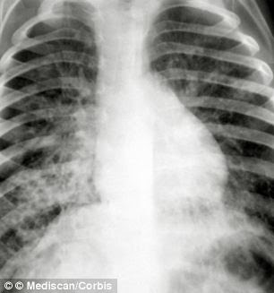 A chest x-ray of a patient with cystic fibrosis