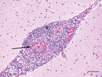 Thumbnail of Cerebellum of dog infected with Hendra virus, showing expansion of the meninges with inflammatory infiltrates (*) and marked vasculitis (arrow). Scale bar indicates 75 μm.
