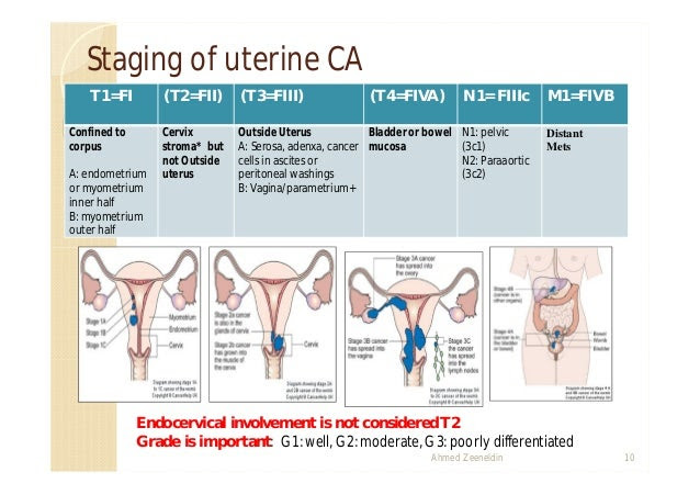 Endometrial most cancers Staging Figo